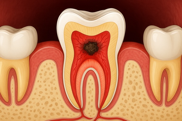 Как спасти зуб, если нерв уже воспалился?