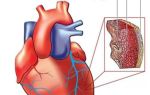 Как снять приступ аритмии сердца в домашних условиях: первая помощь, симптомы и лечение