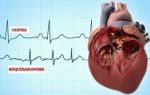 Мерцательная аритмия сердца: лечение народными средствами, отзывы