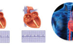 Вторичная кардиомиопатия: что это такое, причина смерти