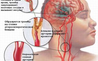 Атеросклероз сонных артерий и вертебральных: что это такое, симптомы, лечение