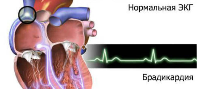 Симптомы и лечение брадикардии, диагностика