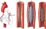 Атеросклероз коронарных артерий: что это такое, стенозирующий тип патологии, поражение церебральных сосудов и аорты