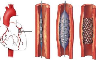 Атеросклероз коронарных артерий: что это такое, стенозирующий тип патологии, поражение церебральных сосудов и аорты