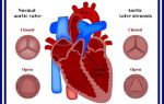 Сочетанный аортальный порок сердца: аускультация, симптомы