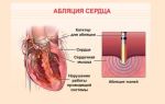 Абляция сердца при мерцательной аритмии: отзывы об рча, стоимость операции