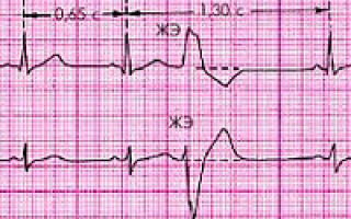 Асистолия желудочков сердца: что это такое, лечение