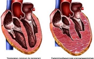 Кардиопатия сердца с нарушением ритма у взрослых: что это такое, симптомы и лечение