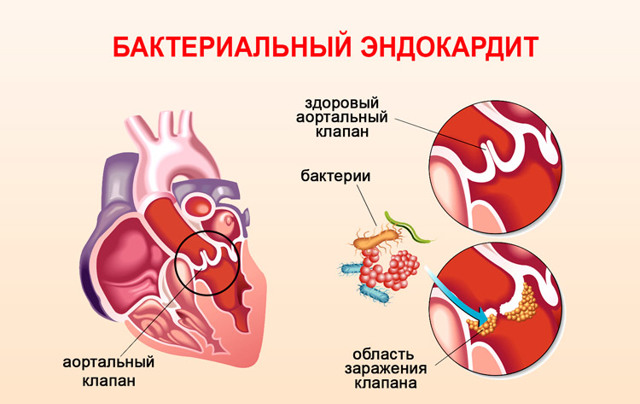 Боли в области сердца после ангины