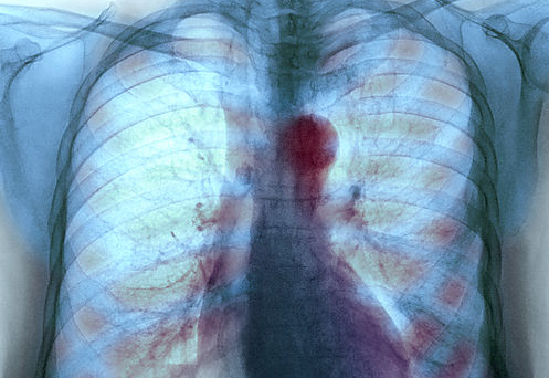 Аневризма грудной части аорты, разорванная смерть: симптомы и диагностика