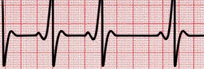 Психогенные экстрасистолы: симптомы, обусловленные неврозом.