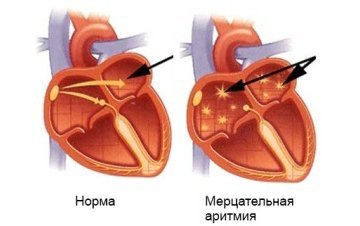 Аритмия сердца: что это такое, симптомы, лечение, причины возникновения
