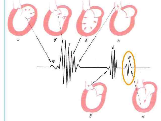Сочетанный аортальный порок сердца: аускультация, симптомы