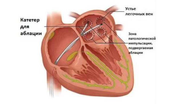 Операция прижигание на сердце при аритмии: отзывы, стоимость, последствия и восстановление
