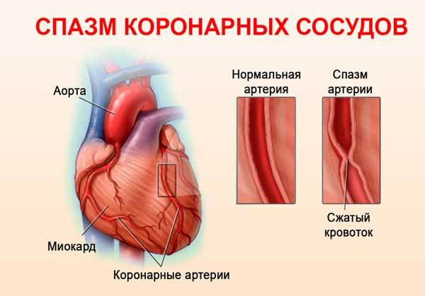 Спазм коронарных сосудов сердца: симптомы