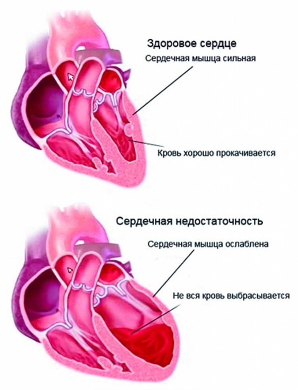 Что такое порок сердца у взрослых: сколько с ним живут, классификация, симптомы и лечение без операции