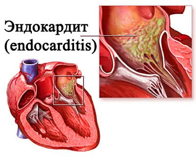 Как называется воспаление сердечной мышцы, симптомы и лечение