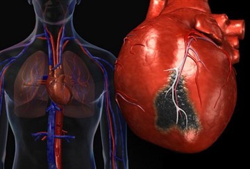 Сколько дней лежат в реанимации после инфаркта: продолжительность больничного листа
