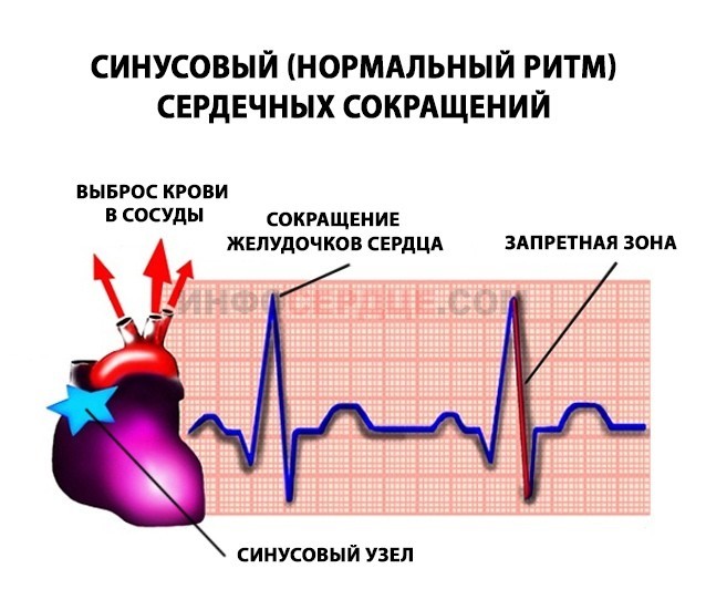 Кардиограмма остановки сердца картинки