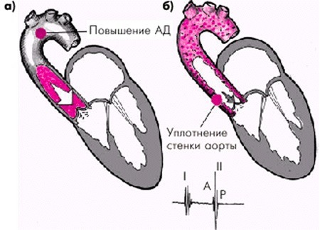 Фиброз, уплотнение створок аортального и митрального клапана: что это такое
