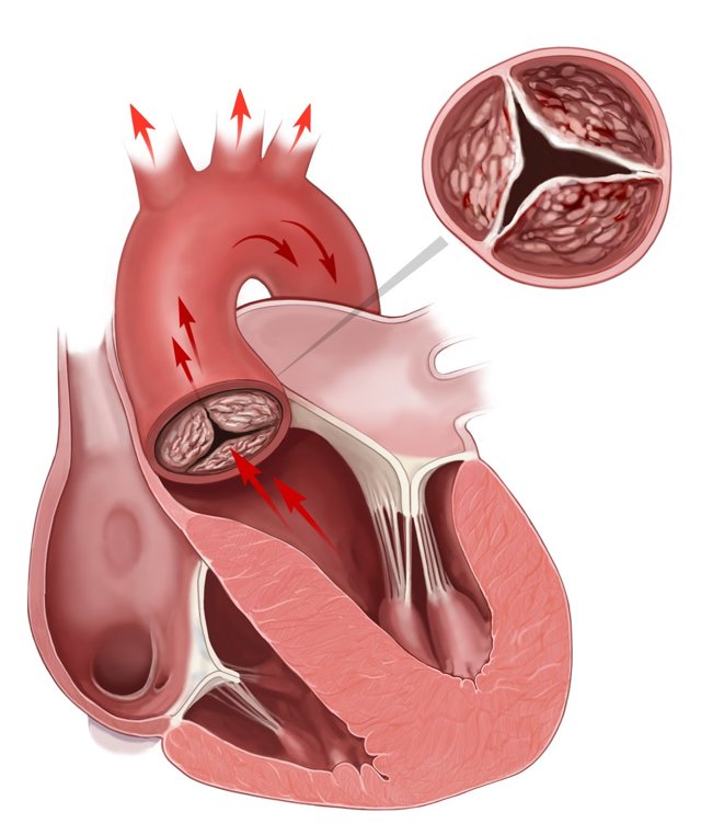 Склероз аорты сердца: что это такое, симптомы и лечение народными средствами