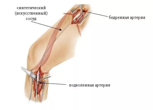 Стенозирующий атеросклреоз: признаки поражения, лечение магистральных артерий нижних конечностей