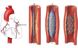 Особенности операции стентирования сосудов сердца и период реабилитации
