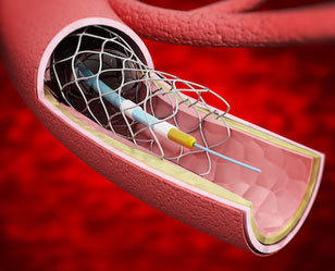 Стеноз сонных артерий: симптомы, лечение, операция и ее стоимость