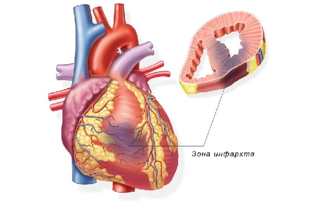 Профилактика инфаркта миокарда: как его избежать, препараты для мужчин и женщин