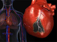 Острый трансмуральный инфаркт передней стенки миокарда на экг: что это такое, прогноз