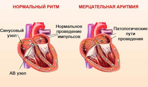 Кардиостимулятор сердца: противопоказания по возрасту, стоимость операции, показания к установке, отзывы пациентов, видео