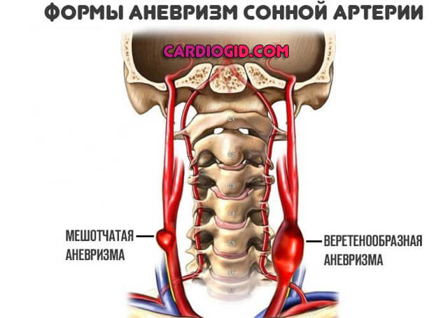 Аневризма сонной артерии шеи: симптомы