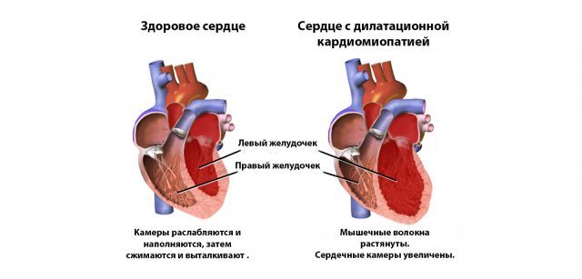 Диспластическая кардиопатия у детей: характеристика заболевания