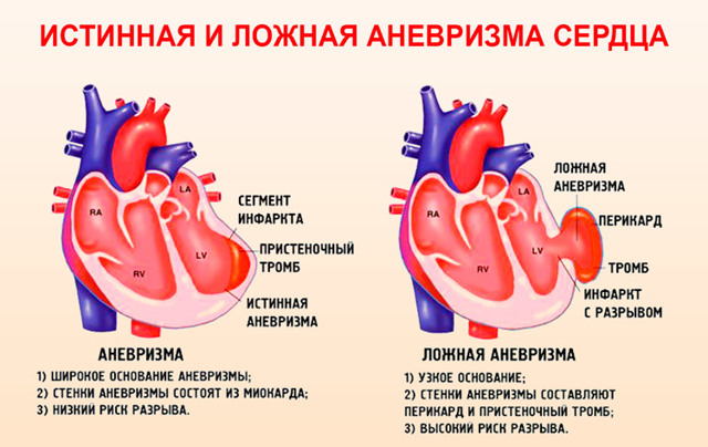 Аневризма сердца: что это такое и как лечить