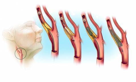 Атеросклероз сонных артерий и вертебральных: что это такое, симптомы, лечение