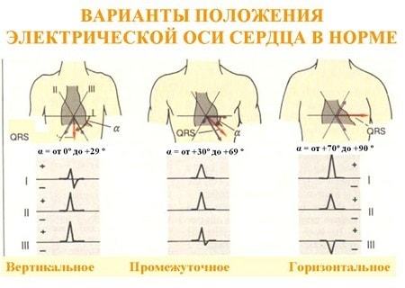 Отклонение электрической оси сердца вправо и вправо, вертикальная позиция у детей: что это такое и что значит