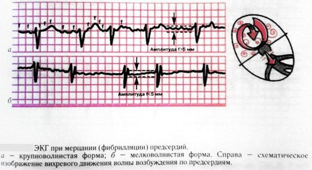 Аритмия сердца: что это такое, симптомы, лечение, причины возникновения