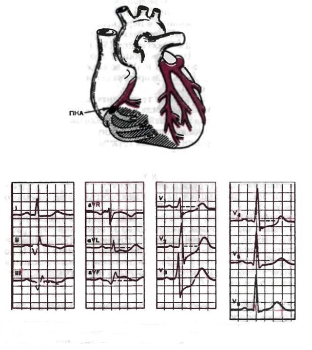 Инфаркт нижней стенки миокарда левого желудочка неопределенной давности: что это такое?