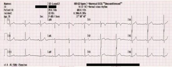 Расшифровка кардиограммы сердца ритм синусовый – что это?