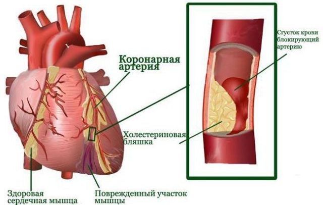 Пульс при инфаркте миокарда и после: норма