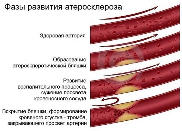 Атеросклероз верхних конечностей: симптомы, лечение сосудов