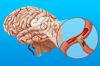 Дистония сосудов головного мозга: симптомы и способы лечения