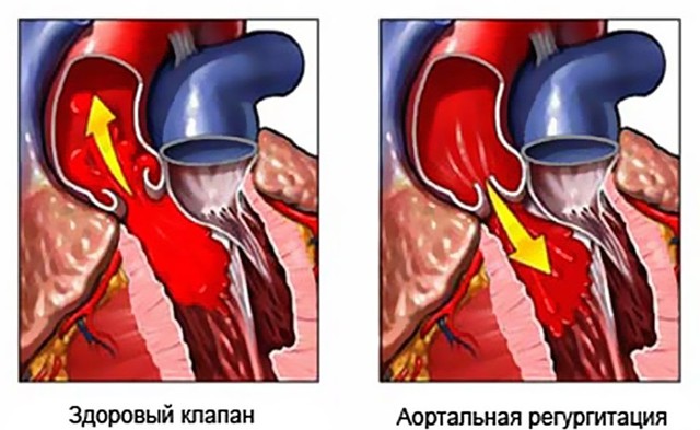 Регургитация аортального клапана 1, 2 степени у ребенка