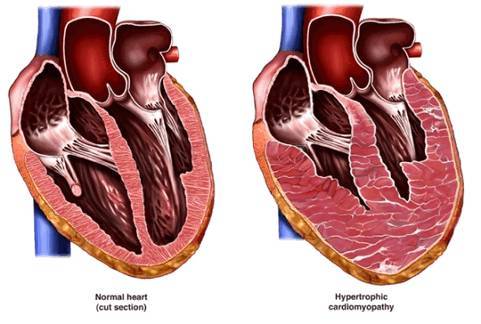 Кардиомегалия у человека: что это, причины болезни, лечение синдрома бычьего сердца