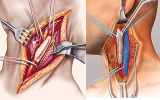 Стеноз сонных артерий: симптомы, лечение, операция и ее стоимость