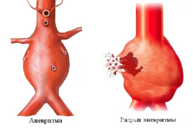 Расслаивающая аневризма аорты: симптомы, диагностика и лечение