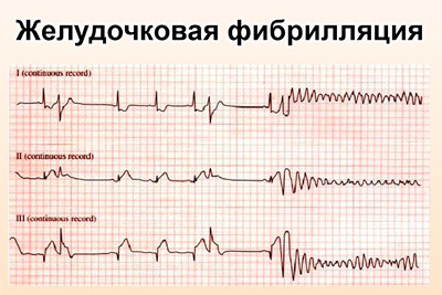 Пульс при инфаркте миокарда и после: норма
