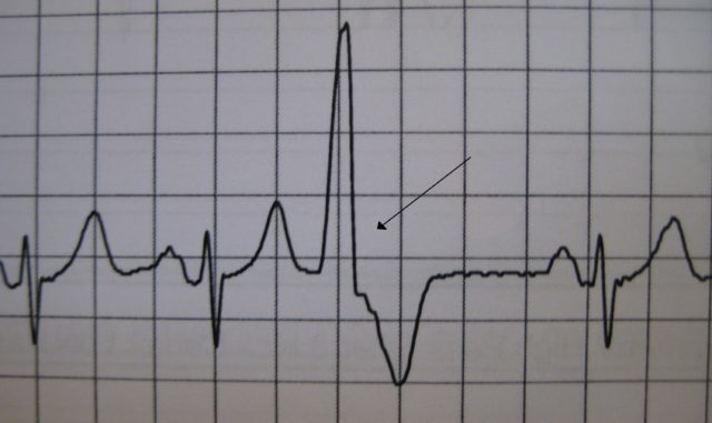 Желудочковая бигеминия сердца: что это такое, лечение