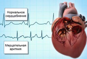 Дилатационная кардиомиопатия у детей: что это такое, причины, симптомы и внезапная смерть, отзывы и прогноз жизни