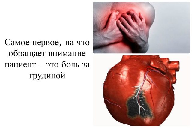 Боли в сердце после инфаркта миокарда